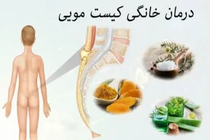درمان خانگی کیست مویی