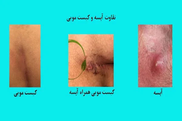 تفاوت کیست مویی با آبسه